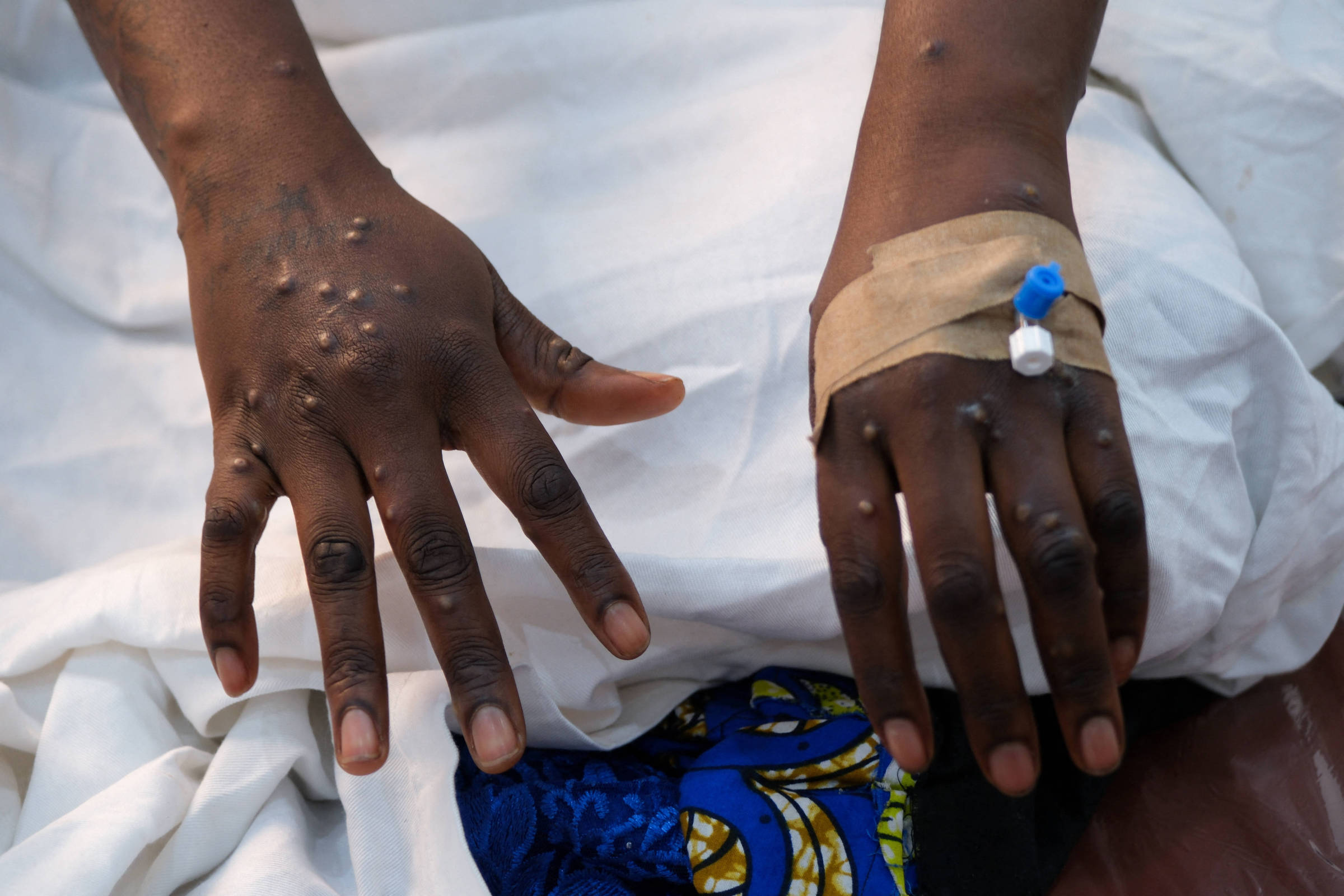 Casos de mpox no Brasil em 2024 superam total de 2023, com foco no Sudeste. Descubra os detalhes e como a doença está se espalhando.